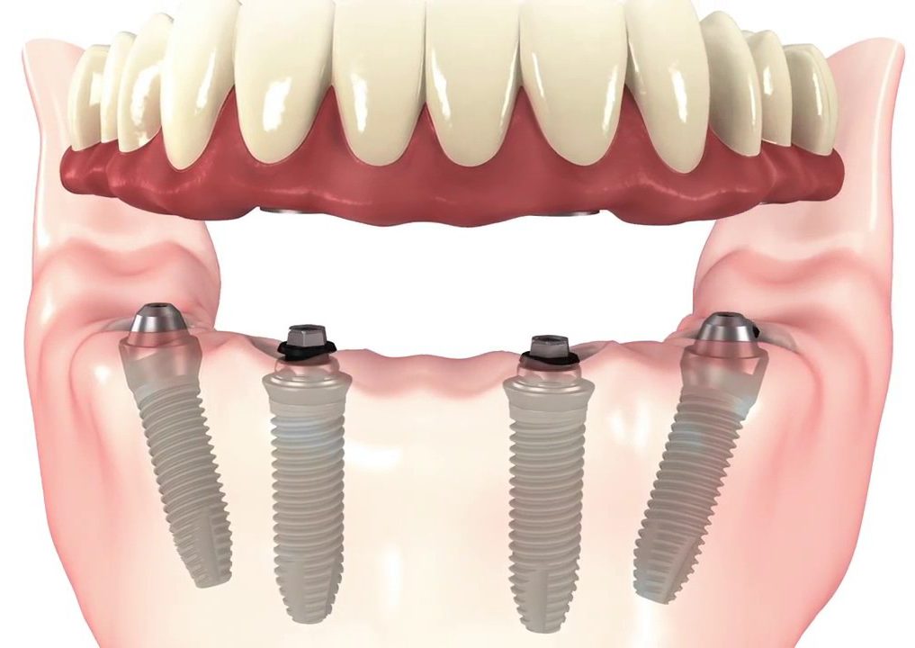 bir günde implant diş