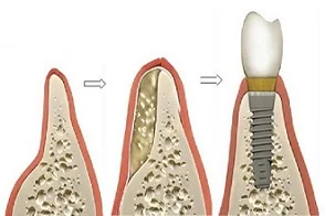 implant tedavisi