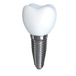 implant diş